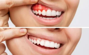 Gum Disease Treatment