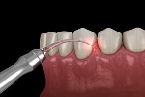 Gum Disease Treatment