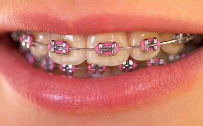 Traditional Braces: Your Complete Guide to Straight Teeth