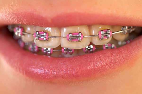 Traditional Braces: Your Complete Guide to Straight Teeth