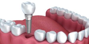 Single Tooth Implants