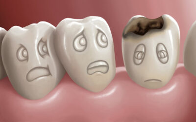 Effective Cavity Prevention and Treatment Strategies for Healthy Smiles