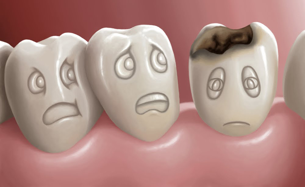 Effective Cavity Prevention and Treatment Strategies for Healthy Smiles