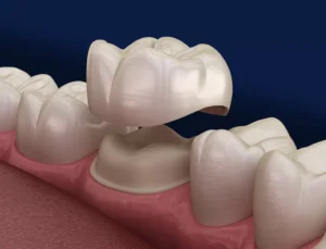 Dental crowns and bridges