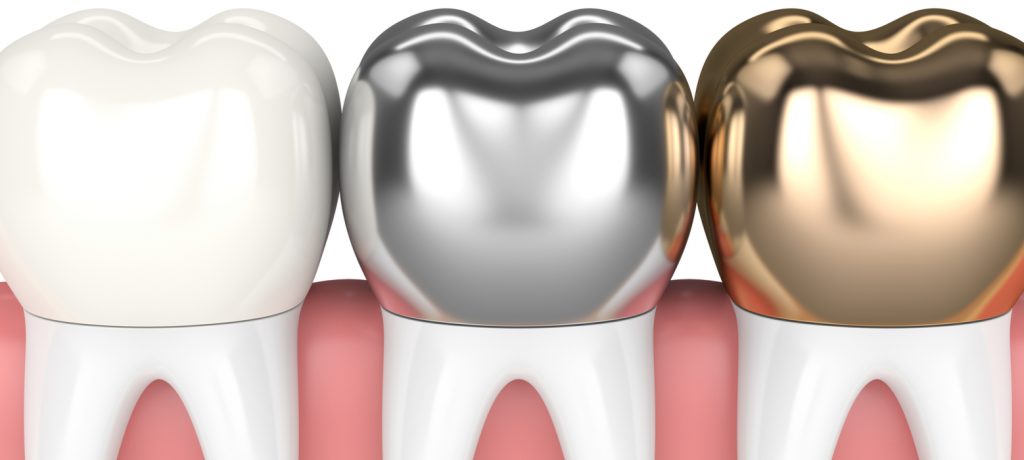 Dental Crowns and Bridges: Your Comprehensive Guide