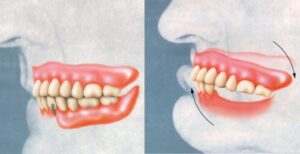 Denture fitting and repair