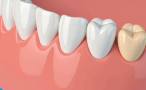 Tooth-colored Fillings