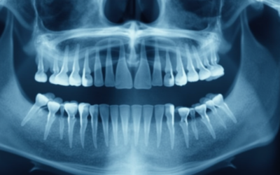 Dental X-rays and Diagnostics: Essential Tools for Oral Health