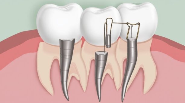 Root Canal Therapy: Your Path to Pain Relief and Lasting Dental Health