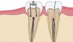 Root canal therapy