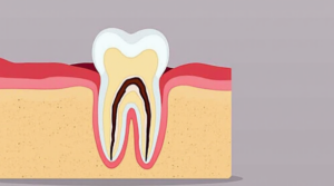 Root canal therapy