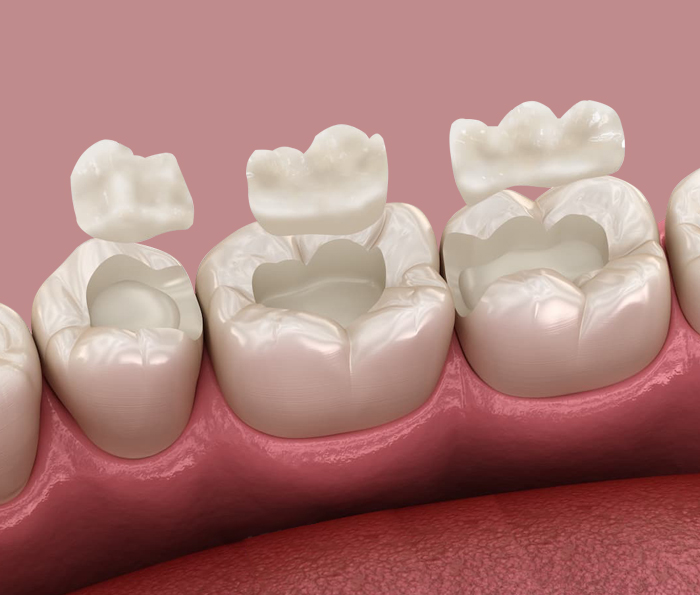 Inlays and Onlays: A Comprehensive Overview