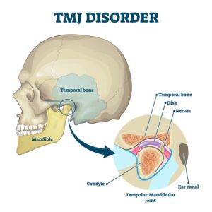 TMJ disorder management