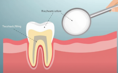 Lost Filling or Crown Replacement: Essential Steps for a Swift Recovery